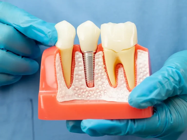 single-tooth-vs-multiple-dental-implants (2)